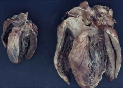 Hypertrophes Herz