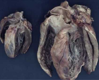 Hypertrophes Herz