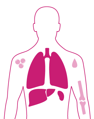 Illustration_torso_morbus_gaucher
