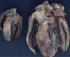 Hypertrophes Herz